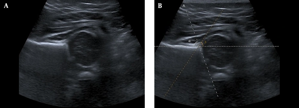 Ultrasonography image for developmental dysplasia of the hip diagnosis. A, Original image; B, Manual selection of α and β angles. Ultrasonography image for developmental dysplasia of the hip diagnosis. A, Original image; B, Manual selection of α and β angles.