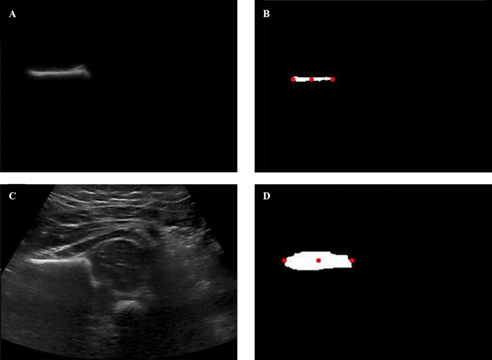 DDH image. A, Manually segmented image; B, Manually segmented image binary for C,R-E,L-E points; C, Raw image; D, Automatically segmented image binary for C,R-E,L-E points (C, Center; R-E, Right-End; L-E, Left-End). DDH image. A, Manually segmented image; B, Manually segmented image binary for C,R-E,L-E points; C, Raw image; D, Automatically segmented image binary for C,R-E,L-E points (C, Center; R-E, Right-End; L-E, Left-End).