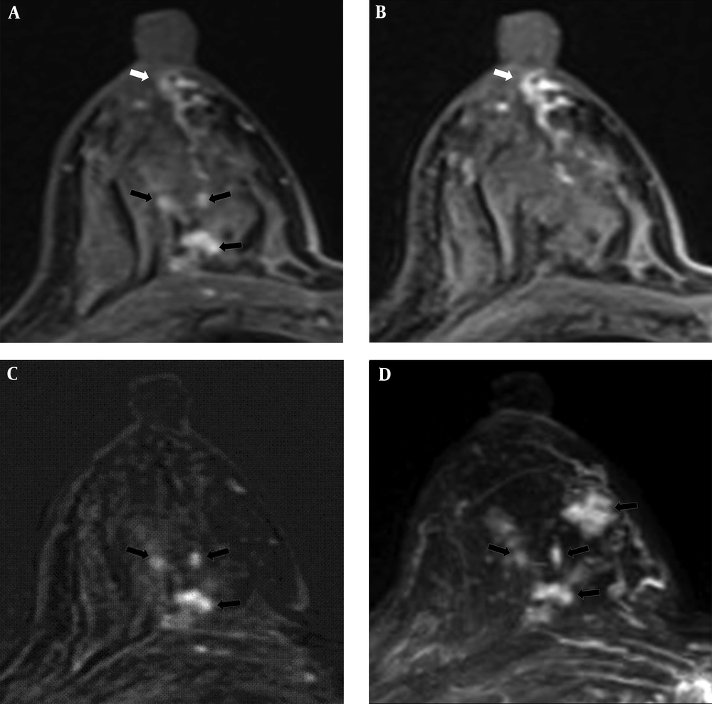A 54-year-old woman had 1.8 cm and 0.8 cm lesions in the right breast that were confirmed as ductal carcinoma in situ by core needle biopsy. Subareolar involvement was confirmed on the pathological report after mastectomy. A, A post-contrast enhanced image revealed multiple enhancing lesions (black arrows) with a subareolar ductal high signal area (white arrow) that was described as BI-RADS category 6. B, A pre-contrast enhanced T1WI exhibiting subareolar ductal pre-contrast high signal area (white arrow). No findings were detected on T2WI. C, Subtraction and D, Maximal intensity projection images reveal multiple enhancing lesions (black arrows). A 54-year-old woman had 1.8 cm and 0.8 cm lesions in the right breast that were confirmed as ductal carcinoma in situ by core needle biopsy. Subareolar involvement was confirmed on the pathological report after mastectomy. A, A post-contrast enhanced image revealed multiple enhancing lesions (black arrows) with a subareolar ductal high signal area (white arrow) that was described as BI-RADS category 6. B, A pre-contrast enhanced T1WI exhibiting subareolar ductal pre-contrast high signal area (white arrow). No findings were detected on T2WI. C, Subtraction and D, Maximal intensity projection images reveal multiple enhancing lesions (black arrows).