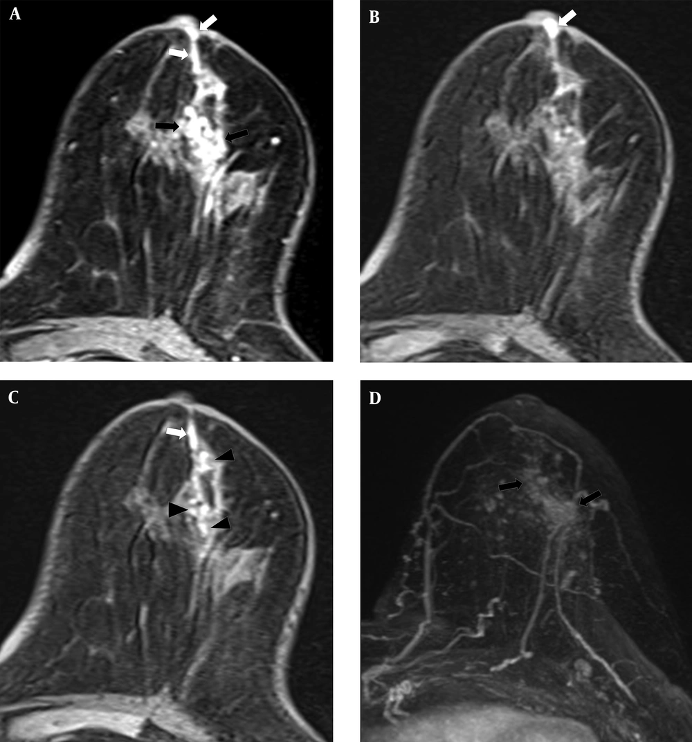 A 67-year-old woman had a 7 cm lesion in the left breast that was confirmed to be invasive ductal cancer and ductal carcinoma in situ by core needle biopsy. Subareolar involvement was not confirmed on the pathological report after mastectomy. A, A post-contrast enhanced image revealing segmental non-mass enhancement (black arrows) with subareolar ductal high signal areas (white arrows) was described as BI-RADS category 6. B and C, A pre-contrast enhanced T1WI exhibiting subareolar ductal (white arrows) and intra-lesional pre-contrast high signal areas (black arrowheads). No findings were detected on T2WI. D, Maximal intensity projection reveals segmental non-mass enhancement (black arrows) without subareolar ductal enhancement. A 67-year-old woman had a 7 cm lesion in the left breast that was confirmed to be invasive ductal cancer and ductal carcinoma in situ by core needle biopsy. Subareolar involvement was not confirmed on the pathological report after mastectomy. A, A post-contrast enhanced image revealing segmental non-mass enhancement (black arrows) with subareolar ductal high signal areas (white arrows) was described as BI-RADS category 6. B and C, A pre-contrast enhanced T1WI exhibiting subareolar ductal (white arrows) and intra-lesional pre-contrast high signal areas (black arrowheads). No findings were detected on T2WI. D, Maximal intensity projection reveals segmental non-mass enhancement (black arrows) without subareolar ductal enhancement.