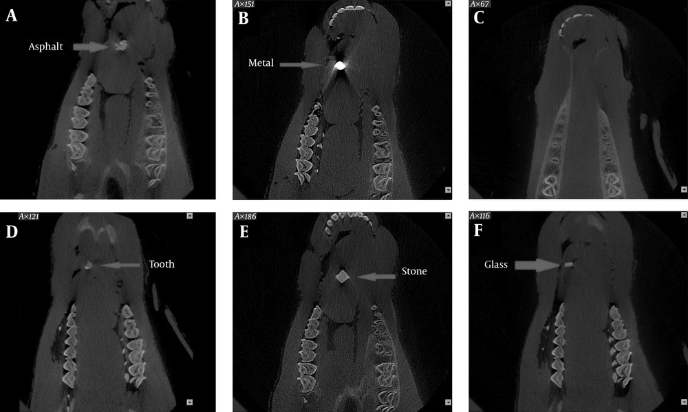 Cone beam computed tomography (CBCT) scans of foreign bodies in the tongue. A, Asphalt; B, Metal; C, Wood; D, Tooth; E,Stone; F, Glass Cone beam computed tomography (CBCT) scans of foreign bodies in the tongue. A, Asphalt; B, Metal; C, Wood; D, Tooth; E,Stone; F, Glass