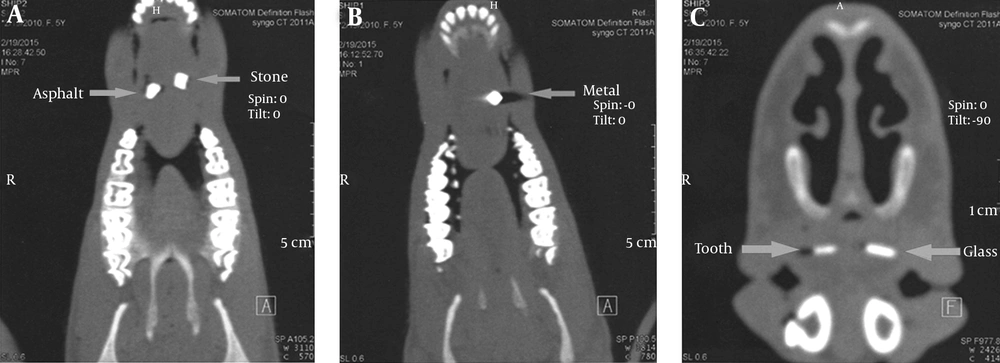 CT scans of the foreign bodies in the tongue. A, Asphalt and stone; B, Wood and metal; C, Tooth and glass CT scans of the foreign bodies in the tongue. A, Asphalt and stone; B, Wood and metal; C, Tooth and glass