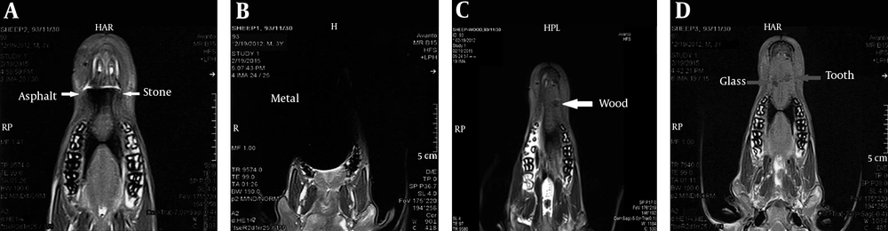 MRI of the foreign bodies in the tongue. A, Asphalt and stone; B, Metal; C, Wood; D, Glass and tooth MRI of the foreign bodies in the tongue. A, Asphalt and stone; B, Metal; C, Wood; D, Glass and tooth