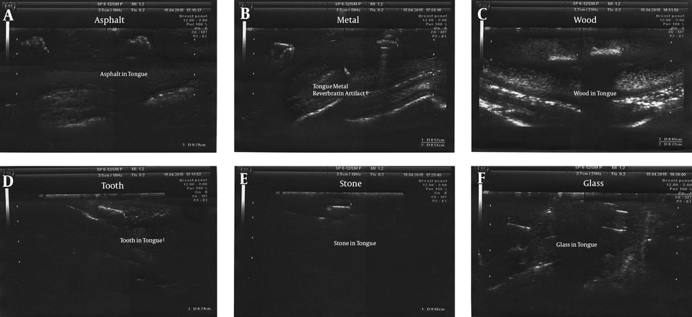 Ultrasound of the foreign bodies in the tongue. A, Asphalt; B, Metal; C, Wood; D, Tooth; E, Stone; F, Glass Ultrasound of the foreign bodies in the tongue. A, Asphalt; B, Metal; C, Wood; D, Tooth; E, Stone; F, Glass