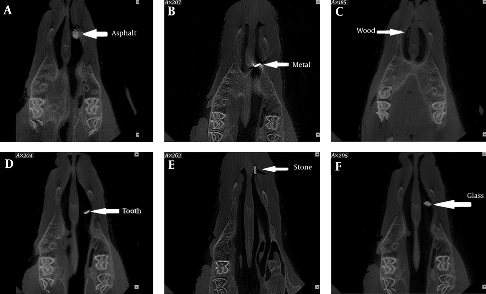 Cone beam computed tomography (CBCT) scans of the foreign bodies in the nose. A, Asphalt; B, Metal; C, Wood; D, Tooth; E, Stone; F, Glass Cone beam computed tomography (CBCT) scans of the foreign bodies in the nose. A, Asphalt; B, Metal; C, Wood; D, Tooth; E, Stone; F, Glass
