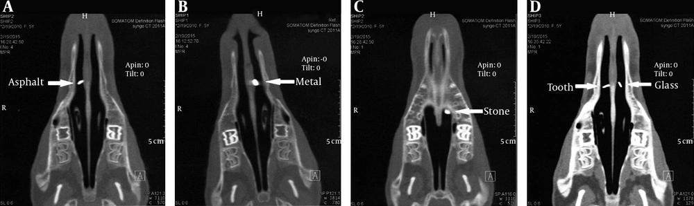 CT scans of the foreign bodies in the nose. A, Asphalt; B, Wood and metal; C, Stone; D, Tooth and glass CT scans of the foreign bodies in the nose. A, Asphalt; B, Wood and metal; C, Stone; D, Tooth and glass