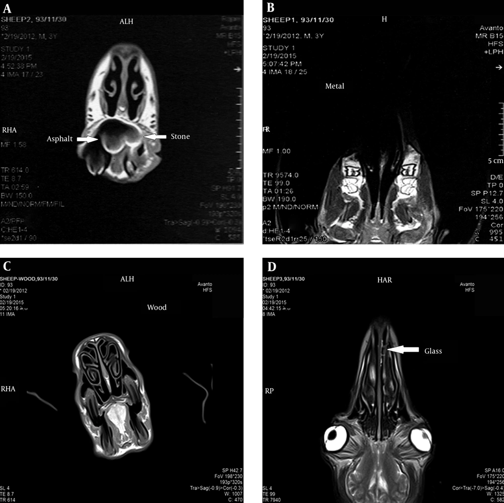 MRI of the foreign bodies in the nose. A, Asphalt and stone; B, Metal; C, Wood; D, Glass and tooth MRI of the foreign bodies in the nose. A, Asphalt and stone; B, Metal; C, Wood; D, Glass and tooth