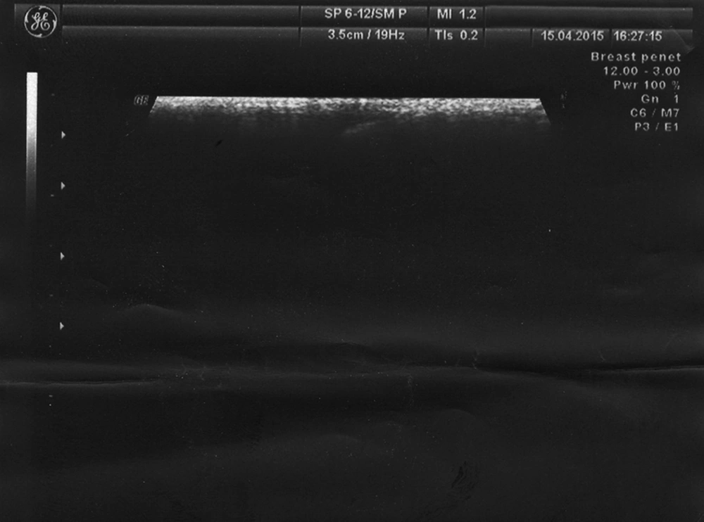Ultrasound of the foreign bodies in the nose Ultrasound of the foreign bodies in the nose