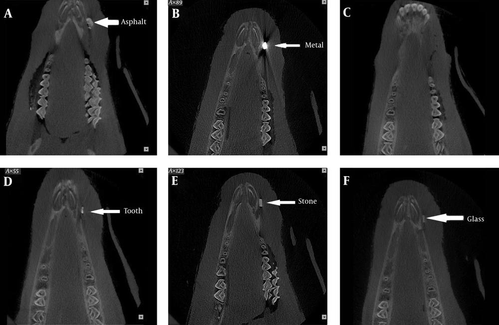 Cone beam computed tomography (CBCT) scans of the foreign bodies in the bone-soft tissue interface. A, Asphalt; B, Metal; C, Wood; D, Tooth; E, Stone; F, Glass Cone beam computed tomography (CBCT) scans of the foreign bodies in the bone-soft tissue interface. A, Asphalt; B, Metal; C, Wood; D, Tooth; E, Stone; F, Glass
