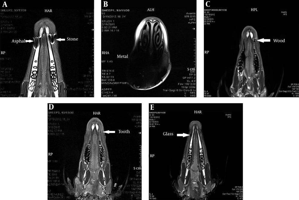 MRI of the foreign bodies in the bone-soft tissue interface. A: Asphalt and stone, B: Metal, C: Wood, D: Tooth, E: Glass MRI of the foreign bodies in the bone-soft tissue interface. A: Asphalt and stone, B: Metal, C: Wood, D: Tooth, E: Glass