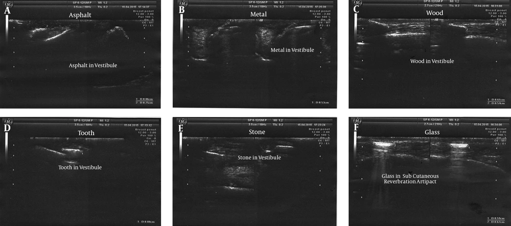 Ultrasound of the foreign bodies in the bone-soft tissue interface. A: Asphalt, B: Metal, C: Wood, D: Tooth, E: Stone, F: Glass Ultrasound of the foreign bodies in the bone-soft tissue interface. A: Asphalt, B: Metal, C: Wood, D: Tooth, E: Stone, F: Glass