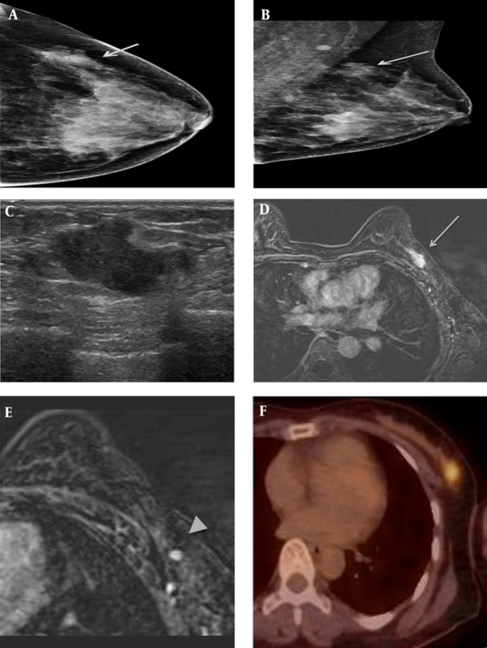 A 41-year-old female patient who presented with a palpable mass in the left breast. A and B, On mammography (A) craniocaudal (CC) view and (B) mediolateral oblique (MLO) view, an irregularly shaped, indistinct marginated isodense mass (solid arrow) was seen in the left upper outer quadrant, where the patient complained of a palpable mass. C, On sonography, an approximately 2.2-cm irregularly shaped, indistinct marginated hypoechoic mass was seen in the left breast in the 1 oāclock direction, 6 cm from the nipple. D&E, On axial fat-saturated T1-weighted 2-minute subtraction imaging, the mass (dashed arrow) was seen as an irregular marginated, oval-shaped mass with relatively homogeneous enhancement, measuring 2.1 Ć 1.1 cm in size. There was also a small enhancing lymph node with cortical thickening in the ipsilateral axilla (arrowhead). F, on 18F-fluorodeoxyglucose positron emission tomography-computed tomography (18FFDG PET-CT) the mass was seen as a focal hypermetabolic lesion. A 41-year-old female patient who presented with a palpable mass in the left breast. A and B, On mammography (A) craniocaudal (CC) view and (B) mediolateral oblique (MLO) view, an irregularly shaped, indistinct marginated isodense mass (solid arrow) was seen in the left upper outer quadrant, where the patient complained of a palpable mass. C, On sonography, an approximately 2.2-cm irregularly shaped, indistinct marginated hypoechoic mass was seen in the left breast in the 1 oāclock direction, 6 cm from the nipple. D&E, On axial fat-saturated T1-weighted 2-minute subtraction imaging, the mass (dashed arrow) was seen as an irregular marginated, oval-shaped mass with relatively homogeneous enhancement, measuring 2.1 Ć 1.1 cm in size. There was also a small enhancing lymph node with cortical thickening in the ipsilateral axilla (arrowhead). F, on 18F-fluorodeoxyglucose positron emission tomography-computed tomography (18FFDG PET-CT) the mass was seen as a focal hypermetabolic lesion.