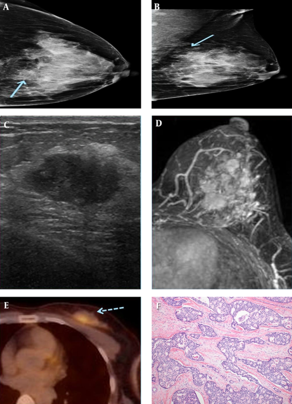 A 49-year-old female patient who presented with a palpable mass in the left breast. A and B, On mammography (A) craniocaudal (CC) view and (B) mediolateral-oblique(MLO) view, an irregularly shaped, indistinct marginated isodense mass (solid arrow) was seen in the left upper inner quadrant. C, An approximately 1.7-cm spiculated, oval-shaped hypoechoic mass was seen in the left breast in the 10 oāclock direction, 4 cm from the nipple on sonography. D, On axial fat-saturated T1-weighted 1-minute subtraction maximum intensity projection (MIP) imaging, multiple variably shaped masses with spiculated margins were seen, which all showed early rapid enhancement with delayed wash-out on dynamic study. E, These tumors exhibited increased FDG uptake (dashed arrow) on 18F-fluorodeoxyglucose positron emission tomography-computed tomography (18FFDG PET-CT). F, On microscopic examination (hematoxylin-eosin stain, original magnification x 100), the tumor is composed of cribriform or fenestrated cellular islands with smooth or angulated contouring. Extensive secondary lumen formation is observed, and some of the lumen is filled with eosinophilic secretion and occasional microcalcification. Unlike cribriform ductal carcinoma in situ (DCIS), desmoplastic stromal reaction is also observed in the background. The tumor cells show low grade of nuclear atypism and mitotic figures are rare. These cells have slightly enlarged nuclei with indistinct nucleoli. A 49-year-old female patient who presented with a palpable mass in the left breast. A and B, On mammography (A) craniocaudal (CC) view and (B) mediolateral-oblique(MLO) view, an irregularly shaped, indistinct marginated isodense mass (solid arrow) was seen in the left upper inner quadrant. C, An approximately 1.7-cm spiculated, oval-shaped hypoechoic mass was seen in the left breast in the 10 oāclock direction, 4 cm from the nipple on sonography. D, On axial fat-saturated T1-weighted 1-minute subtraction maximum intensity projection (MIP) imaging, multiple variably shaped masses with spiculated margins were seen, which all showed early rapid enhancement with delayed wash-out on dynamic study. E, These tumors exhibited increased FDG uptake (dashed arrow) on 18F-fluorodeoxyglucose positron emission tomography-computed tomography (18FFDG PET-CT). F, On microscopic examination (hematoxylin-eosin stain, original magnification x 100), the tumor is composed of cribriform or fenestrated cellular islands with smooth or angulated contouring. Extensive secondary lumen formation is observed, and some of the lumen is filled with eosinophilic secretion and occasional microcalcification. Unlike cribriform ductal carcinoma in situ (DCIS), desmoplastic stromal reaction is also observed in the background. The tumor cells show low grade of nuclear atypism and mitotic figures are rare. These cells have slightly enlarged nuclei with indistinct nucleoli.