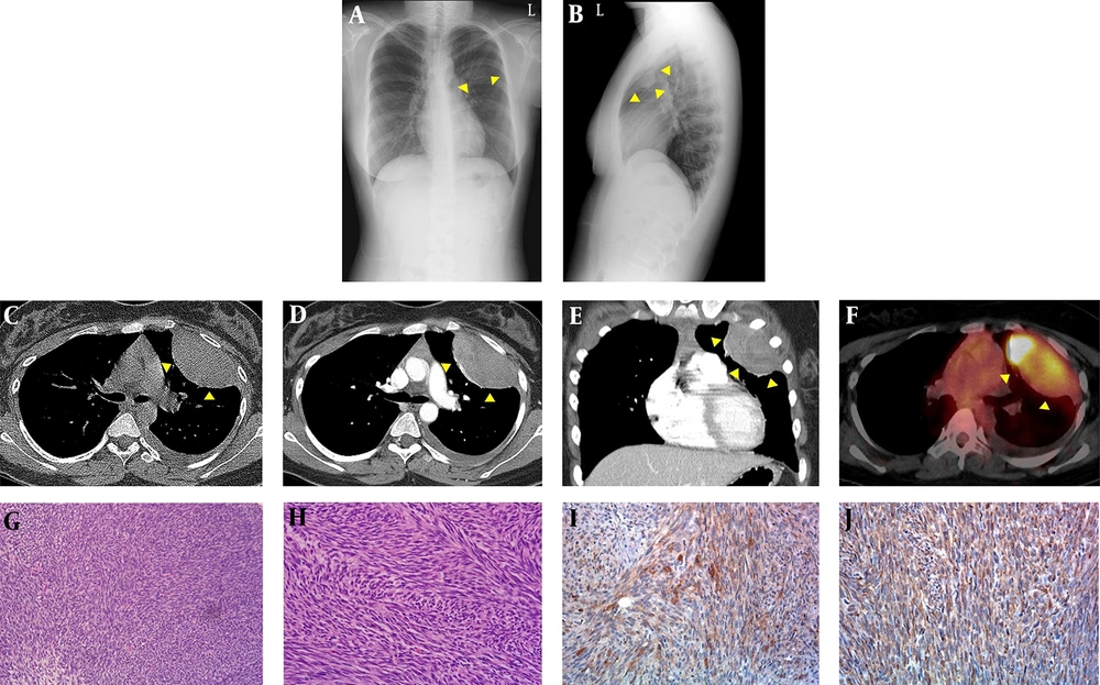 A, B, Chest radiographs; C, chest CT; D, positron emission tomography (PET)-CT; E – G, microscopic features of primary pleuropulmonary synovial sarcoma (PPSS) in a 17-year-old female. A posteroanterior; B, left lateral chest radiographs show a well-circumscribed round mass (arrowheads in A and B) in the left upper hemithorax; C, precontrast; D, contrast-enhanced CT axial; E coronal images of the chest show a well-circumscribed, oval-shaped mass (arrowheads in C, D and E) with heterogeneous enhancement abutting the pleura in the left upper hemithorax and a small amount of high-density fluid in the precontrast image; F, axial F-18 fluorodeoxyglucose positron emission tomography-CT (18F FDG PET/CT) shows increased FDG uptake in the mass (arrowheads in F), with a maximum standardized uptake value of 31.7; G, the tumor is composed of tightly packed fascicles of spindle cells (hematoxylin and eosin (H - E) staining, × 100); H, a fibrosarcoma-like area showing distinct intersecting fascicles (a herringbone pattern) is also noted (H - E staining, × 200); I, patchy expression of epithelial membrane antigen (EMA) is evident (EMA staining, × 200); J, the tumor expressed CD99 in a diffuse cytoplasmic staining pattern (CD99 staining, × 200). A, B, Chest radiographs; C, chest CT; D, positron emission tomography (PET)-CT; E – G, microscopic features of primary pleuropulmonary synovial sarcoma (PPSS) in a 17-year-old female. A posteroanterior; B, left lateral chest radiographs show a well-circumscribed round mass (arrowheads in A and B) in the left upper hemithorax; C, precontrast; D, contrast-enhanced CT axial; E coronal images of the chest show a well-circumscribed, oval-shaped mass (arrowheads in C, D and E) with heterogeneous enhancement abutting the pleura in the left upper hemithorax and a small amount of high-density fluid in the precontrast image; F, axial F-18 fluorodeoxyglucose positron emission tomography-CT (18F FDG PET/CT) shows increased FDG uptake in the mass (arrowheads in F), with a maximum standardized uptake value of 31.7; G, the tumor is composed of tightly packed fascicles of spindle cells (hematoxylin and eosin (H - E) staining, × 100); H, a fibrosarcoma-like area showing distinct intersecting fascicles (a herringbone pattern) is also noted (H - E staining, × 200); I, patchy expression of epithelial membrane antigen (EMA) is evident (EMA staining, × 200); J, the tumor expressed CD99 in a diffuse cytoplasmic staining pattern (CD99 staining, × 200).