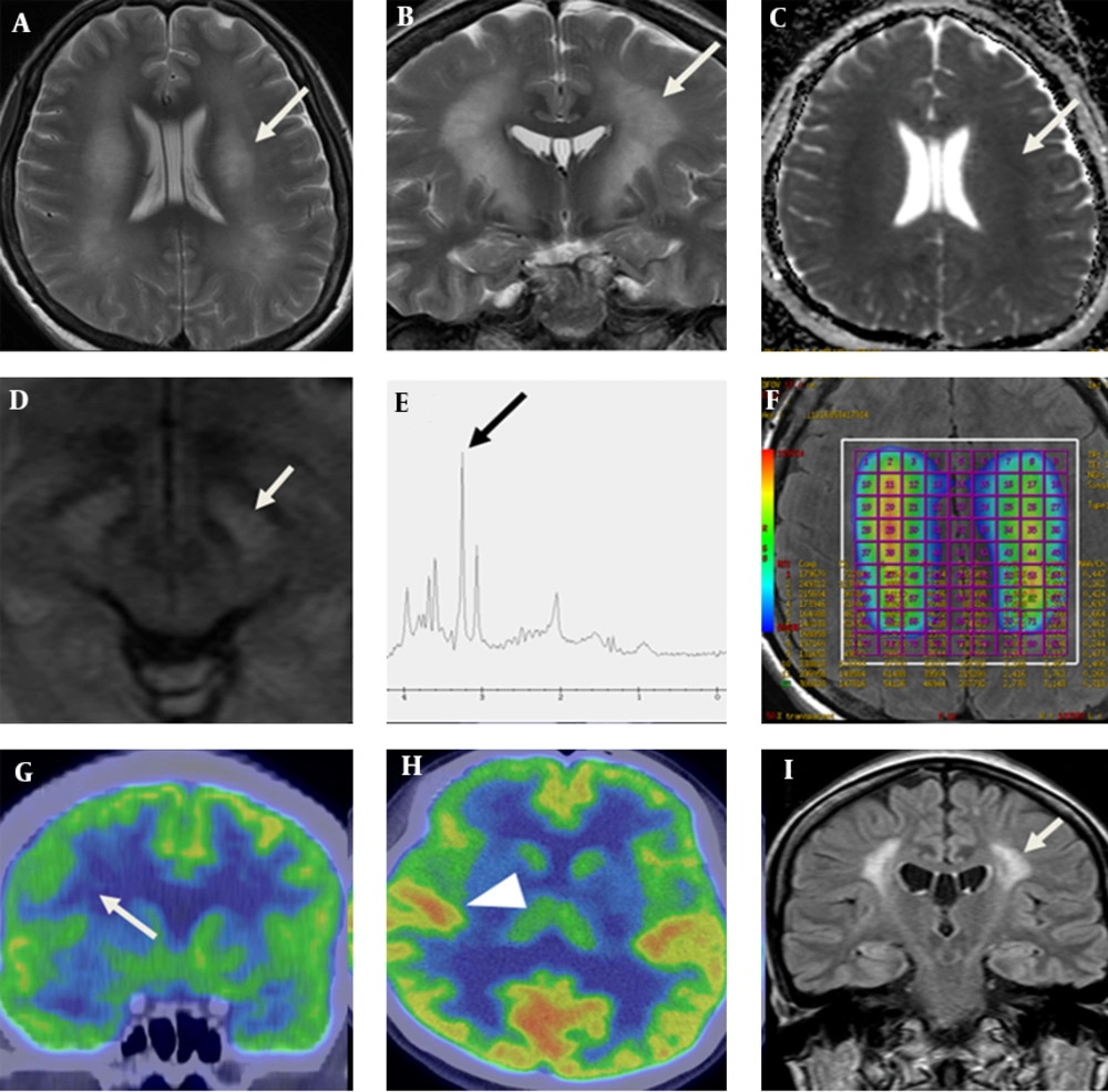 A 36-year-old woman with neuropsychiatric SLE. Axial (A) and coronal (B) T2 weighted magnetic resonance imaging show diffuse and symmetric hyperintense areas of the bilateral cerebral white matter including the corticobulbar tract (white arrow), which shows slight diffusion restriction on ADC map (C). At the level of midbrain, high signal intensities (arrow) are detected in the medial side of crus cerebri on diffusion-weighted image (D). MR spectroscopy (E) shows increased choline (arrow) and myo-inositol peaks and decreased NAA peak. Color coding map of multi-voxel MRS (F) shows increased ratio of choline/creatinine. Coronal (G) and axial view (H) of PET CT shows decreased FDG uptake on the middle and inferior frontal gyri (arrow) sparing other cortex (arrow head). Post treatment follow up FLAIR image of MRI (I) shows decreased area of high signal intensity (arrow) of the white matter compared with initial presentation after nine months. A 36-year-old woman with neuropsychiatric SLE. Axial (A) and coronal (B) T2 weighted magnetic resonance imaging show diffuse and symmetric hyperintense areas of the bilateral cerebral white matter including the corticobulbar tract (white arrow), which shows slight diffusion restriction on ADC map (C). At the level of midbrain, high signal intensities (arrow) are detected in the medial side of crus cerebri on diffusion-weighted image (D). MR spectroscopy (E) shows increased choline (arrow) and myo-inositol peaks and decreased NAA peak. Color coding map of multi-voxel MRS (F) shows increased ratio of choline/creatinine. Coronal (G) and axial view (H) of PET CT shows decreased FDG uptake on the middle and inferior frontal gyri (arrow) sparing other cortex (arrow head). Post treatment follow up FLAIR image of MRI (I) shows decreased area of high signal intensity (arrow) of the white matter compared with initial presentation after nine months.