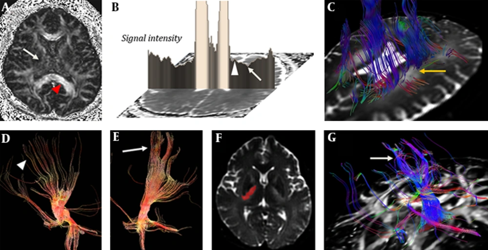 FA map in a patient with neuropsychiatric SLE (A) shows decreased value of internal capsule (arrow) compared with the corpus callosum (arrowhead). ADC map (B) shows diffusion restriction in the lateral portion of the periventricular white matter (arrow) with relatively spared medial portion (arrowhead) at the level of corona radiata. DTI tractography (C) shows fibers defect (arrow) on T2 high signal intensity. The fibers passing the medial three-fourth portion of crus cerebri (D, arrowhead) are more sparse than fibers passing through the lateral portion of crus cerebri (E, arrow). Diffusion tensor tractography shows the corticobulbar tract (G, arrow) which passes through a high signal intensity lesion (signal intensity<1450) on b=0 image of DWI (F, mask imaging). FA map in a patient with neuropsychiatric SLE (A) shows decreased value of internal capsule (arrow) compared with the corpus callosum (arrowhead). ADC map (B) shows diffusion restriction in the lateral portion of the periventricular white matter (arrow) with relatively spared medial portion (arrowhead) at the level of corona radiata. DTI tractography (C) shows fibers defect (arrow) on T2 high signal intensity. The fibers passing the medial three-fourth portion of crus cerebri (D, arrowhead) are more sparse than fibers passing through the lateral portion of crus cerebri (E, arrow). Diffusion tensor tractography shows the corticobulbar tract (G, arrow) which passes through a high signal intensity lesion (signal intensity<1450) on b=0 image of DWI (F, mask imaging).