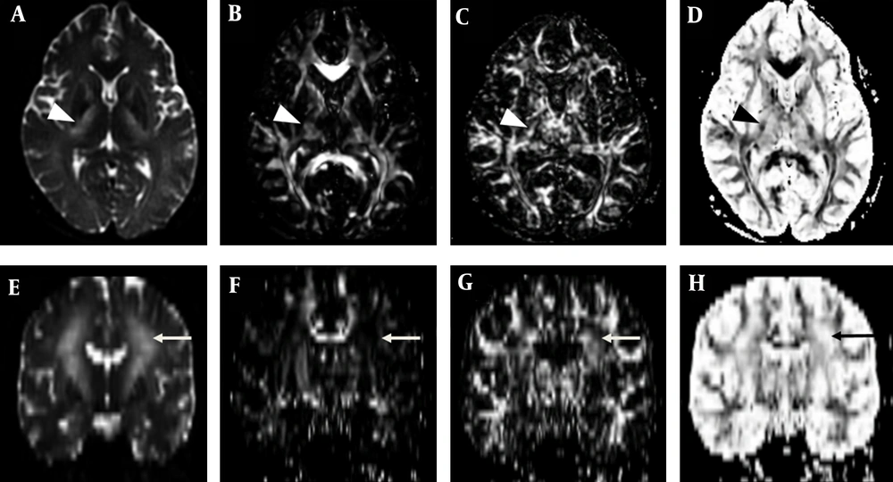 Parametric anisotropy maps in a patient with neuropsychiatric systemic lupus erythematosus (SLE). A-D, Axial images of B0 diffusion tensor image, parametric intensity maps of combination linear (Cl), combination planar (Cp), and combination spherical (Cs) measures at the level of basal ganglia. E-H, Coronal images of B0 diffusion tensor image, Cl, Cp, and Cs. Affected lesion including corticobulbar tract (arrow) shows low, high and high signal intensity on Cl, Cp and Cs map, respectively; whereas, the corticospinal tracts (arrow head) show high, high, and low signal intensity, respectively, which was similar to unaffected white matter tracts. Parametric anisotropy maps in a patient with neuropsychiatric systemic lupus erythematosus (SLE). A-D, Axial images of B0 diffusion tensor image, parametric intensity maps of combination linear (Cl), combination planar (Cp), and combination spherical (Cs) measures at the level of basal ganglia. E-H, Coronal images of B0 diffusion tensor image, Cl, Cp, and Cs. Affected lesion including corticobulbar tract (arrow) shows low, high and high signal intensity on Cl, Cp and Cs map, respectively; whereas, the corticospinal tracts (arrow head) show high, high, and low signal intensity, respectively, which was similar to unaffected white matter tracts.