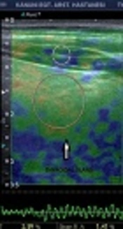 Cover image of the article: Value of Real-Time and Strain Ratio Elastography in Differential Diagnosis of Graves’ Disease and Subacute and Hashimoto’s Thyroiditis