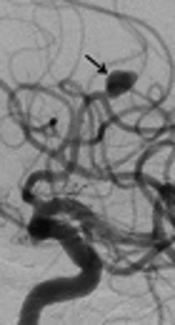 The Efficacy of Flow Diverter Stents in the Treatment of Wide-Necked Intracranial Aneurysms