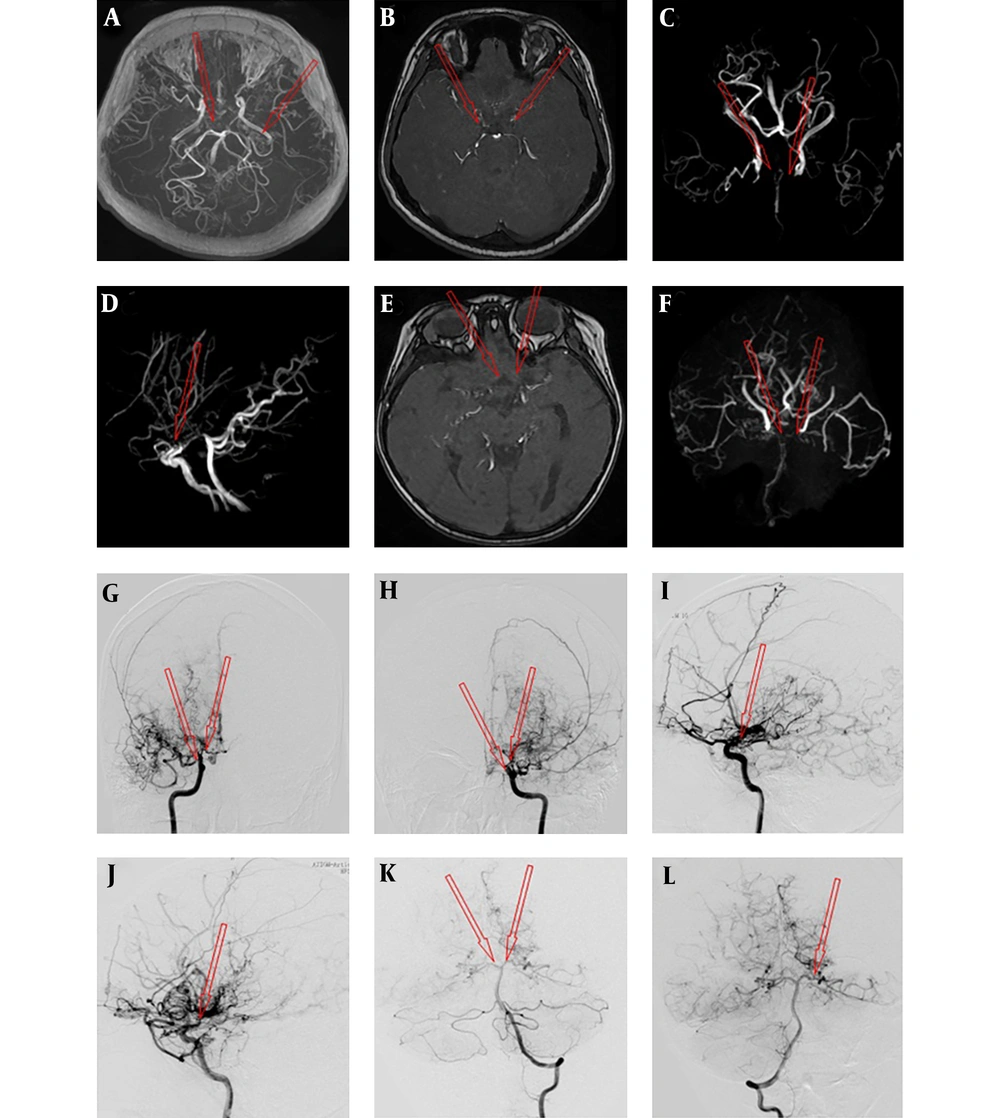 A case with moyamoya disease (MMD) was assessed by magnetic resonance angiography (MRA) (A-F) and digital subtraction angiography (DSA) (G-L). The arrow shows smoke-like vessels of the internal carotid artery (ICA), anterior cerebral artery (ACA) and middle cerebral artery (MCA); A, No evidence in the M1 segment of bilateral MCA; B, Occlusion in the A1 segment of bilateral ACA; C, Occlusion in the C1 segment of bilateral ICA; D, Occlusion of the bilateral ACA; E and F, Occlusion in the A1 segment of bilateral ACA and the M1 segment of bilateral MCA as well as smoke-like vessels of distal vessels; G and H, Occlusion in the C1 segment of the right ICA and posterior cerebral artery (PCA) visualization; I, Occlusion in the C1 segment of the left ICA and PCA visualization; J, Stenosis in the left MCA (K) and bilateral PCA (L). A case with moyamoya disease (MMD) was assessed by magnetic resonance angiography (MRA) (A-F) and digital subtraction angiography (DSA) (G-L). The arrow shows smoke-like vessels of the internal carotid artery (ICA), anterior cerebral artery (ACA) and middle cerebral artery (MCA); A, No evidence in the M1 segment of bilateral MCA; B, Occlusion in the A1 segment of bilateral ACA; C, Occlusion in the C1 segment of bilateral ICA; D, Occlusion of the bilateral ACA; E and F, Occlusion in the A1 segment of bilateral ACA and the M1 segment of bilateral MCA as well as smoke-like vessels of distal vessels; G and H, Occlusion in the C1 segment of the right ICA and posterior cerebral artery (PCA) visualization; I, Occlusion in the C1 segment of the left ICA and PCA visualization; J, Stenosis in the left MCA (K) and bilateral PCA (L).
