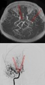 Comparative Performance of Magnetic Resonance Angiography and Digital Subtraction Angiography in Vessel Involvement of Pediatric Moyamoya Disease