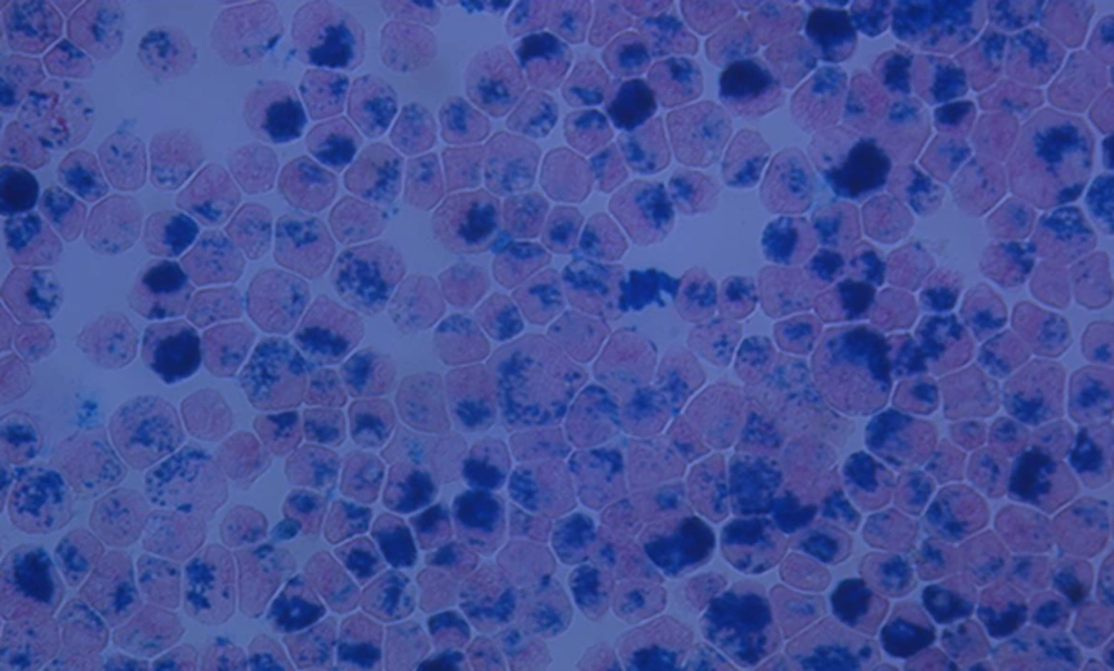 Prussian blue-stained Feridex-labeled mesenchymal stem cells. Mesenchymal stem cells were labeled with superparamagnetic iron oxide (SPIO) nanoparticles for intracellular magnetic labeling and the efficacy of the labeling was examined under a microscope after Prussian blue staining (× 1000). Prussian blue-stained Feridex-labeled mesenchymal stem cells. Mesenchymal stem cells were labeled with superparamagnetic iron oxide (SPIO) nanoparticles for intracellular magnetic labeling and the efficacy of the labeling was examined under a microscope after Prussian blue staining (× 1000).