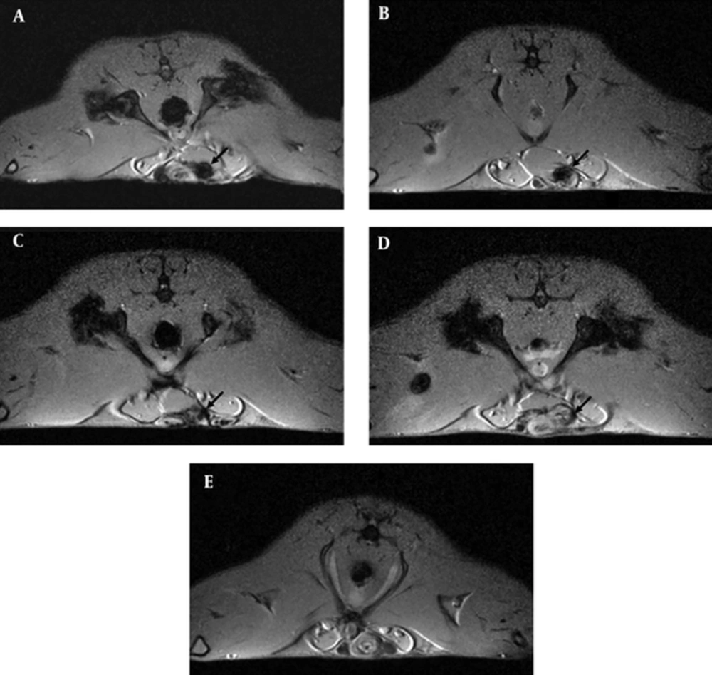 In vivo magnetic resonance (MR) imaging with superparamagnetic iron oxide (SPIO)-labeled mesenchymal stem cells after transection of bilateral cavernosal nerves. A - E, Short axis T1-weighted gradient-echo MR imaging of rats showed the distinct hypointensity (indicated by arrows) at the penis 4 weeks (A) after injection. The size of hypointensity became smaller gradually in rats after 8 (B), 12 (C), and 16 (D) weeks of injection. Conversely, no signal change was detected in a media-injected control rat (E). In vivo magnetic resonance (MR) imaging with superparamagnetic iron oxide (SPIO)-labeled mesenchymal stem cells after transection of bilateral cavernosal nerves. A - E, Short axis T1-weighted gradient-echo MR imaging of rats showed the distinct hypointensity (indicated by arrows) at the penis 4 weeks (A) after injection. The size of hypointensity became smaller gradually in rats after 8 (B), 12 (C), and 16 (D) weeks of injection. Conversely, no signal change was detected in a media-injected control rat (E).
