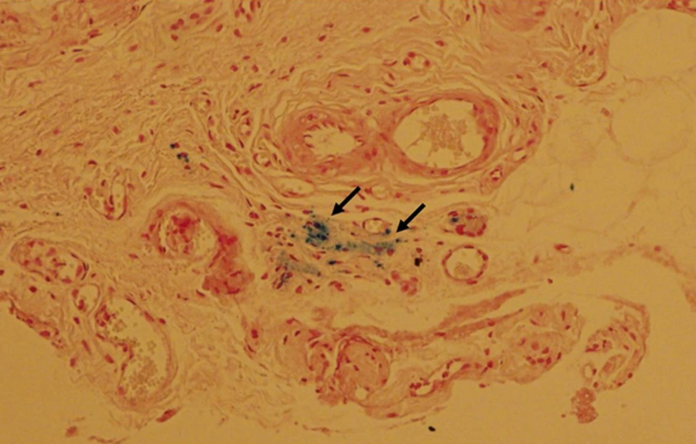 Histological analysis of superparamagnetic iron oxide (SPIO)-labeled mesenchymal stem cells with Prussian blue staining. Rats at 8 weeks after injection of SPIO-labeled mesenchymal stem cells into the corpus cavernosum were sacrificed and the tissue was stained with Prussia blue staining. Hypointensities detected by MR imaging were visible as blue stained area (indicated by arrows) by histological examination with Prussian blue staining, indicating the presence of the intra-cytoplasmic SPIO particles in the hypointensity. Histological analysis of superparamagnetic iron oxide (SPIO)-labeled mesenchymal stem cells with Prussian blue staining. Rats at 8 weeks after injection of SPIO-labeled mesenchymal stem cells into the corpus cavernosum were sacrificed and the tissue was stained with Prussia blue staining. Hypointensities detected by MR imaging were visible as blue stained area (indicated by arrows) by histological examination with Prussian blue staining, indicating the presence of the intra-cytoplasmic SPIO particles in the hypointensity.