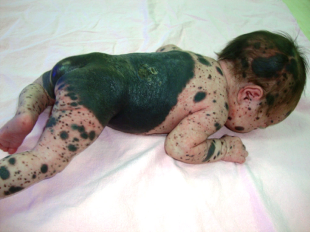 side effects of melanotan ii Atypical (dysplastic) melanocytic naevus main image 0