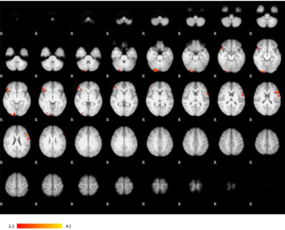 The main effects of VCN. Whole-brain analysis reveals left lateralized activation in the inferior frontal gyrus. VCN tasks mainly produced activation in the left inferior frontal gyrus, right inferior frontal gyrus, right lateral occipital gyrus, right occipital fusiform gyrus, right occipital pole, and right orbital frontal cortex. Results are displayed at a significance threshold of P < 0.05, corrected for family-wise error. The main effects of VCN. Whole-brain analysis reveals left lateralized activation in the inferior frontal gyrus. VCN tasks mainly produced activation in the left inferior frontal gyrus, right inferior frontal gyrus, right lateral occipital gyrus, right occipital fusiform gyrus, right occipital pole, and right orbital frontal cortex. Results are displayed at a significance threshold of P < 0.05, corrected for family-wise error.