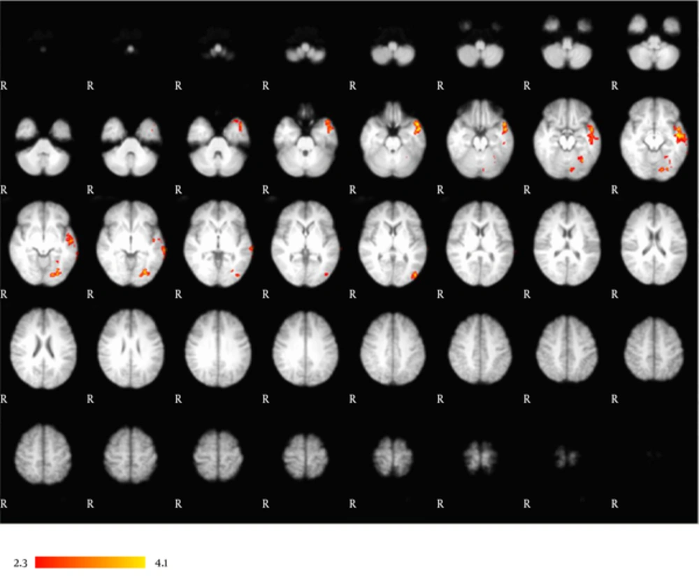 Correlational analysis. Left-dominant activation in an occipitotemporal network correlates with subjects’ VCN performance. This network is comprised of the left occipital fusiform gyrus, left temporal occipital fusiform gyrus, left middle temporal gyrus, left superior temporal gyrus, and left temporal pole. Results are displayed at a significance threshold of P < 0.05, corrected for family-wise error. Correlational analysis. Left-dominant activation in an occipitotemporal network correlates with subjects’ VCN performance. This network is comprised of the left occipital fusiform gyrus, left temporal occipital fusiform gyrus, left middle temporal gyrus, left superior temporal gyrus, and left temporal pole. Results are displayed at a significance threshold of P < 0.05, corrected for family-wise error.