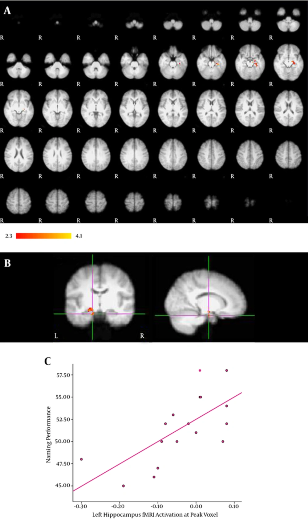 ROI analysis of the hippocampus. A, Activation in the left hippocampus significantly correlated with VCN performance; B, The activation map displaying the correlation of fMRI signal with VCN performance at peak voxel in the left hippocampus; C, A diagram illustrating how VCN performance score is related to fMRI activation at peak voxel. Greater fMRI activation was related to better VCN performance score. Results are displayed at a significance threshold of P < 0.05, corrected for family-wise error. ROI analysis of the hippocampus. A, Activation in the left hippocampus significantly correlated with VCN performance; B, The activation map displaying the correlation of fMRI signal with VCN performance at peak voxel in the left hippocampus; C, A diagram illustrating how VCN performance score is related to fMRI activation at peak voxel. Greater fMRI activation was related to better VCN performance score. Results are displayed at a significance threshold of P < 0.05, corrected for family-wise error.