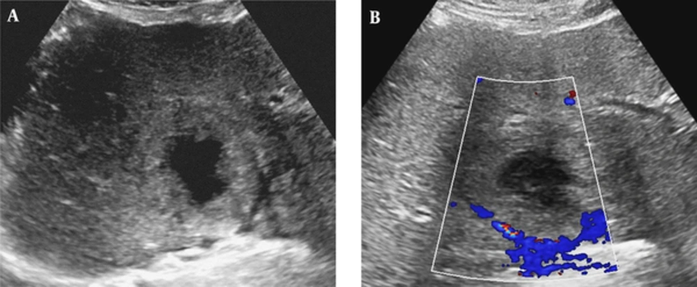 Ultrasonography (US) of a 57-year-old man with a 6.5 cm solitary peliosis hepatis undergoing a large central cystic change. A, Grayscale transabdominal US shows an ill-defined hyperechoic lesion in S4 of the liver. An irregular large anechoic cystic content is noted in the central portion of the lesion; B, Color Doppler US shows no increased vascularity of the lesion. Ultrasonography (US) of a 57-year-old man with a 6.5 cm solitary peliosis hepatis undergoing a large central cystic change. A, Grayscale transabdominal US shows an ill-defined hyperechoic lesion in S4 of the liver. An irregular large anechoic cystic content is noted in the central portion of the lesion; B, Color Doppler US shows no increased vascularity of the lesion.