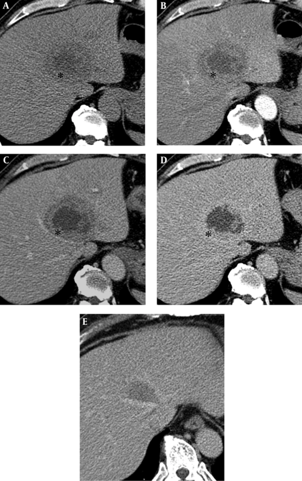 Multidetector computed tomography (CT) of a 57-year-old man with a 6.5 cm solitary peliosis hepatis undergoing a large central cystic change. A, A pre-contrast axial CT scan shows an ill-defined lesion with a triple layered appearance. The central portion is of low density, and the middle irregular thick layer (*) shows as isodense compared with the adjacent liver parenchyma, while the outer layer shows a hypodense rim similar to perilesional edema; B, C, After contrast medium enhancement, the middle irregular thick layer (*) shows strong enhancement from the arterial to delayed phase; D, A perilesional low density halo disappeared at the delayed phase. The central low density area does not show any enhancement; E, PH has been decreased in size from 6.5 cm to 3.5 cm 2 months after conservative treatment with antibiotics. Multidetector computed tomography (CT) of a 57-year-old man with a 6.5 cm solitary peliosis hepatis undergoing a large central cystic change. A, A pre-contrast axial CT scan shows an ill-defined lesion with a triple layered appearance. The central portion is of low density, and the middle irregular thick layer (*) shows as isodense compared with the adjacent liver parenchyma, while the outer layer shows a hypodense rim similar to perilesional edema; B, C, After contrast medium enhancement, the middle irregular thick layer (*) shows strong enhancement from the arterial to delayed phase; D, A perilesional low density halo disappeared at the delayed phase. The central low density area does not show any enhancement; E, PH has been decreased in size from 6.5 cm to 3.5 cm 2 months after conservative treatment with antibiotics.