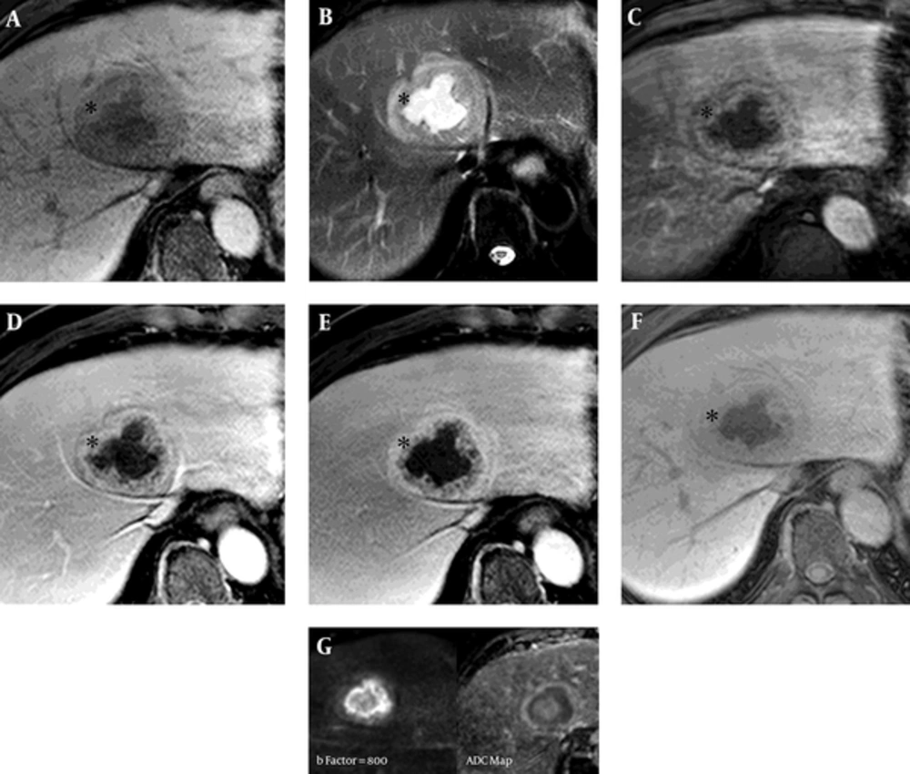Liver magnetic resonance imaging (MRI) of a 57-year-old man with a 6.5 cm solitary peliosis hepatis undergoing a large central cystic change. A, Liver MRI was performed using dynamic imaging, including imaging in the arterial phase (C, 30 seconds), portal venous phase (D, 60 seconds), and transitional phase (E, 3 minutes), as well as the hepatobiliary phase (F, 20 minutes), after administration of 0.1 mmol/kg Gd-EOB-DTPA. The lesion is hypointense on pre-contrast T1-weighted imaging; B, On T2-weighted half-Fourier acquisition turbo spin-echo images, it shows a triple signal intensity. The central area shows as hyperintense, similar to cerebrospinal fluid, and the thick middle layer (*) shows iso- to slight hyperintensity compared with the adjacent liver parenchyma; C - E, The peripheral area shows as a hyperintense halo. In comparison with the CT scans, the thick middle layer (*) surrounding the central cystic lesion shows more intense enhancement compared with the adjacent liver parenchyma from the arterial to the transitional phase (3 minutes); F, On hepatobiliary phase, the thick middle layer (*) has been enhanced, but less strongly than the adjacent liver parenchyma; G, The enhancing peripheral lesion shows decreased diffusivity on diffusion weighted image (b factor, 800) and ADC map (ADC, 1.04 × 10<sup>-3</sup>mm<sup>2</sup>/s). Liver magnetic resonance imaging (MRI) of a 57-year-old man with a 6.5 cm solitary peliosis hepatis undergoing a large central cystic change. A, Liver MRI was performed using dynamic imaging, including imaging in the arterial phase (C, 30 seconds), portal venous phase (D, 60 seconds), and transitional phase (E, 3 minutes), as well as the hepatobiliary phase (F, 20 minutes), after administration of 0.1 mmol/kg Gd-EOB-DTPA. The lesion is hypointense on pre-contrast T1-weighted imaging; B, On T2-weighted half-Fourier acquisition turbo spin-echo images, it shows a triple signal intensity. The central area shows as hyperintense, similar to cerebrospinal fluid, and the thick middle layer (*) shows iso- to slight hyperintensity compared with the adjacent liver parenchyma; C - E, The peripheral area shows as a hyperintense halo. In comparison with the CT scans, the thick middle layer (*) surrounding the central cystic lesion shows more intense enhancement compared with the adjacent liver parenchyma from the arterial to the transitional phase (3 minutes); F, On hepatobiliary phase, the thick middle layer (*) has been enhanced, but less strongly than the adjacent liver parenchyma; G, The enhancing peripheral lesion shows decreased diffusivity on diffusion weighted image (b factor, 800) and ADC map (ADC, 1.04 × 10<sup>-3</sup>mm<sup>2</sup>/s).