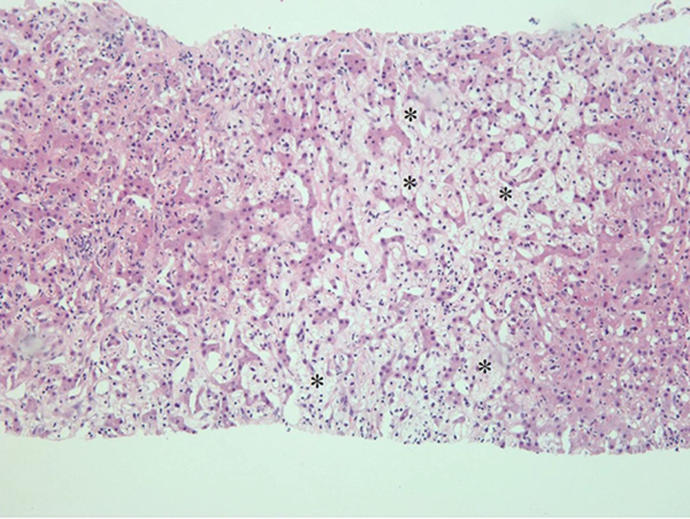 Photomicroscopic image shows dilatation of the sinusoid (*) (hematoxylin and eosin, × 100). Photomicroscopic image shows dilatation of the sinusoid (*) (hematoxylin and eosin, × 100).