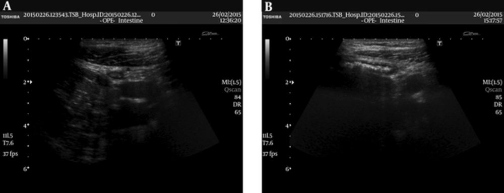 Normal appendix (A) transverse and (B) longitudinal views obtained with a 7 MHZ linear probe. There is no sign of inflammation/increased echogenity, lymph nodes or free fluid in surrounding tissue. The patient was included in US group 1. Appendix vermiformis is pathologically confirmed to be normal. Normal appendix (A) transverse and (B) longitudinal views obtained with a 7 MHZ linear probe. There is no sign of inflammation/increased echogenity, lymph nodes or free fluid in surrounding tissue. The patient was included in US group 1. Appendix vermiformis is pathologically confirmed to be normal.