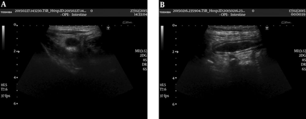Inflamed appendix (A) transverse and (B) longitudinal views obtained with a 7 MHZ linear probe. Appendix vermiformis is enlarged and hypoechoic. Wall of the appendix is also enlarged. Periappendiceal fat is hyperechoic secondary to inflammation. The patient was included in US group 4. Appendix vermiformis is pathologically confirmed to be inflamed. Inflamed appendix (A) transverse and (B) longitudinal views obtained with a 7 MHZ linear probe. Appendix vermiformis is enlarged and hypoechoic. Wall of the appendix is also enlarged. Periappendiceal fat is hyperechoic secondary to inflammation. The patient was included in US group 4. Appendix vermiformis is pathologically confirmed to be inflamed.