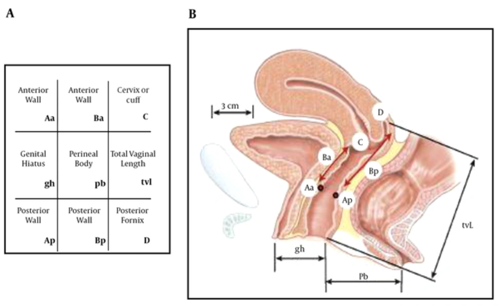 Stages of pelvic organ prolapse. A, Three-by-three grid for recording quantitative description of pelvic organ support. B, Six sites (points Aa - Ba - C - D - Bp - Ap) - genital hiatus (gh) - perineal body (pb) and vaginal length (tvl) used for pelvic organ support quantitation. Stages of pelvic organ prolapse. A, Three-by-three grid for recording quantitative description of pelvic organ support. B, Six sites (points Aa - Ba - C - D - Bp - Ap) - genital hiatus (gh) - perineal body (pb) and vaginal length (tvl) used for pelvic organ support quantitation.
