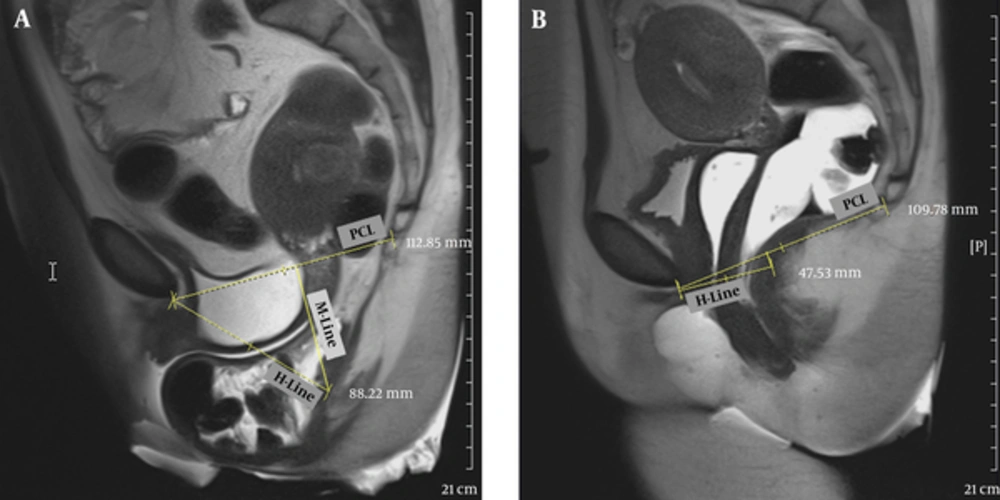 A 44-year-old female with chief complaints of obstructed defecation, frequency and mixed urinary incontinence (urge and stress). A, Midsagittal T2 HASTE during rest shows pubococcygeal line (PCL) between the inferior margin of symphysis pubis and last horizontally oriented coccygeal line. H-line is between the inferior margin of symphysis pubis and posterior aspect of anorectal angle. M-line is between PCL and H-Line; B, Midsagittal T2 HASTE during straining shows small cystocele, moderate apical descent and large rectal descent with anterior rectocele. A 44-year-old female with chief complaints of obstructed defecation, frequency and mixed urinary incontinence (urge and stress). A, Midsagittal T2 HASTE during rest shows pubococcygeal line (PCL) between the inferior margin of symphysis pubis and last horizontally oriented coccygeal line. H-line is between the inferior margin of symphysis pubis and posterior aspect of anorectal angle. M-line is between PCL and H-Line; B, Midsagittal T2 HASTE during straining shows small cystocele, moderate apical descent and large rectal descent with anterior rectocele.