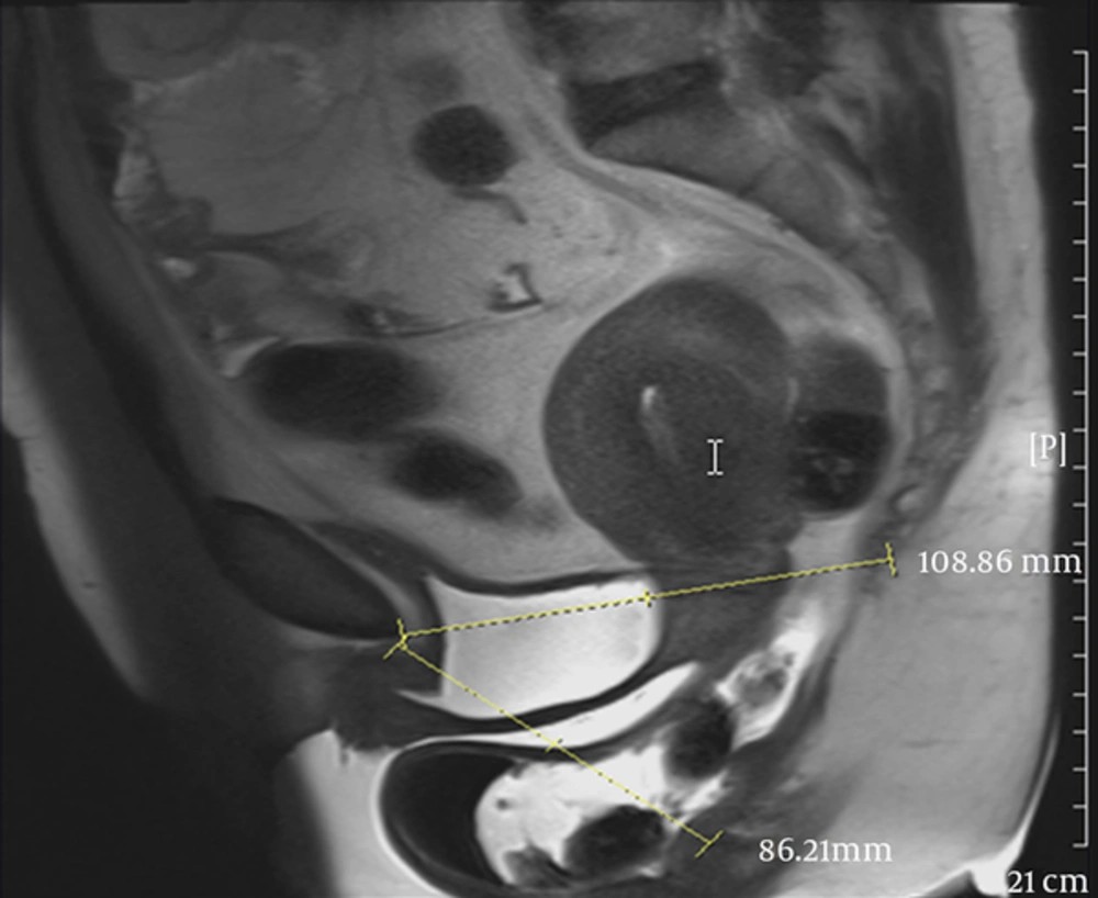 A 33-year-old female with stress urinary incontinence. Image in mid sagittal T2 HASTE during straining shows moderate cystocele, cyctourethrocele, urethral hypermobility, and funneling. A 33-year-old female with stress urinary incontinence. Image in mid sagittal T2 HASTE during straining shows moderate cystocele, cyctourethrocele, urethral hypermobility, and funneling.