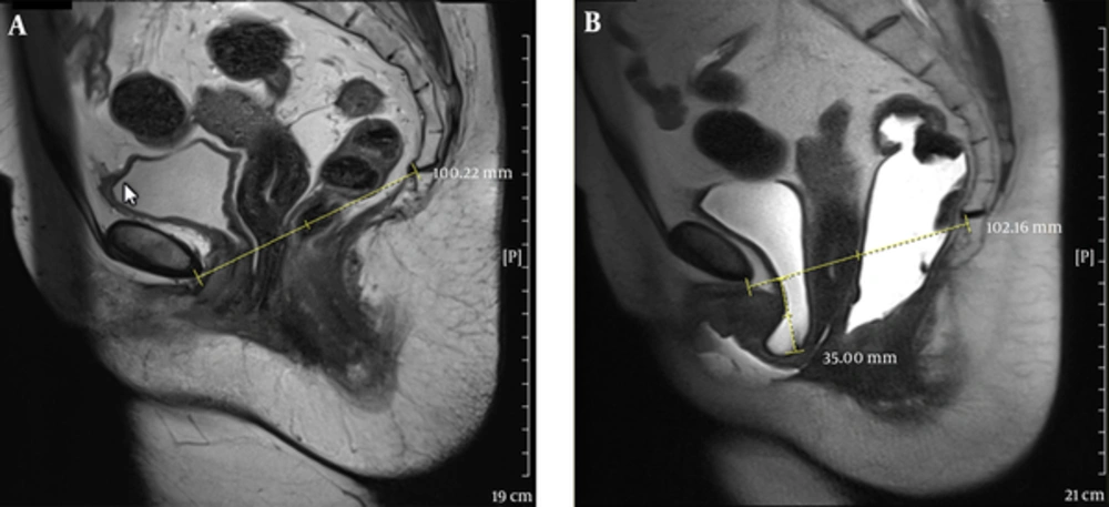 A 50-year-old female with dyspareunia. A, Midsagittal T2 HASTE during rest shows the bladder neck at the level of pubococcygeal line (PCL). B, Midsagittal T2 HASTE during straining shows multi-compartment defect including large cystocele and urethral hypermobility, urethral kink with resultant bladder outlet obstruction and trabeculated bladder, large apical descent and rectal descent. A 50-year-old female with dyspareunia. A, Midsagittal T2 HASTE during rest shows the bladder neck at the level of pubococcygeal line (PCL). B, Midsagittal T2 HASTE during straining shows multi-compartment defect including large cystocele and urethral hypermobility, urethral kink with resultant bladder outlet obstruction and trabeculated bladder, large apical descent and rectal descent.