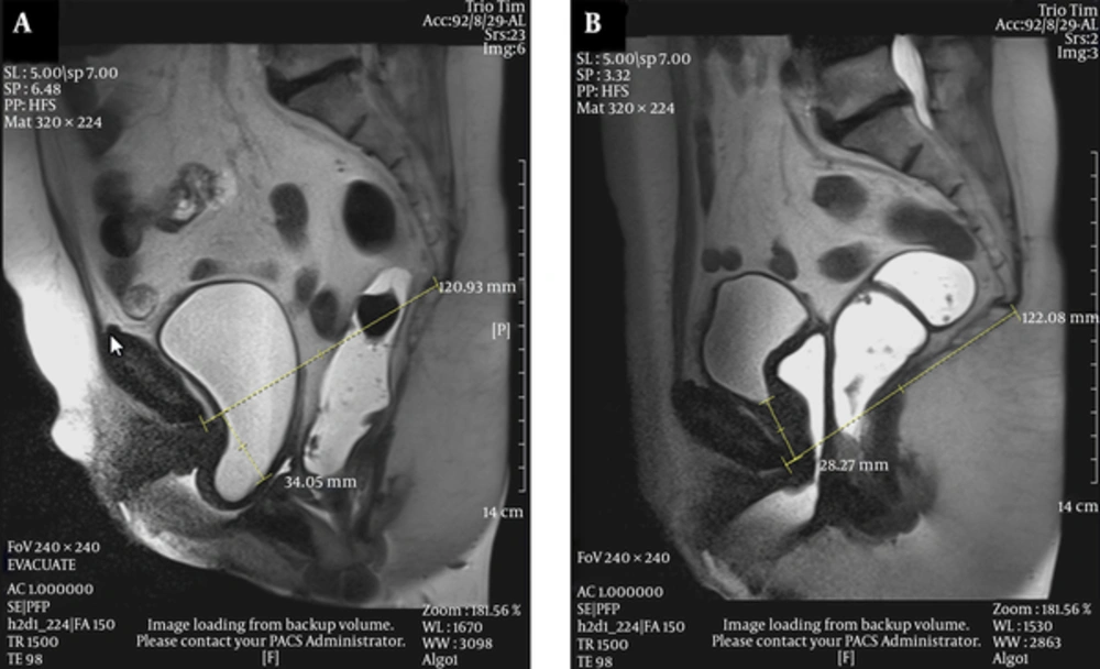 A 67-year-old female with prior history of hysterectomy came with urge urinary incontinence. A, Midsagittal T2 HASTE during rest shows normal position of the bladder neck, vaginal apex and anorectal junction. B, Midsagittal T2 HASTE during straining shows moderate cystocele and urethral hypermobility, large apical prolapse and large rectal descent. A 67-year-old female with prior history of hysterectomy came with urge urinary incontinence. A, Midsagittal T2 HASTE during rest shows normal position of the bladder neck, vaginal apex and anorectal junction. B, Midsagittal T2 HASTE during straining shows moderate cystocele and urethral hypermobility, large apical prolapse and large rectal descent.