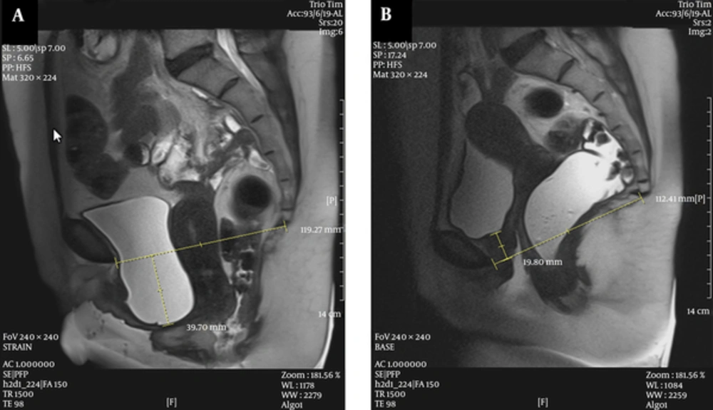 A 48-year-old female with perineal mass protrusion. A, Midsagittal T2 HASTE during rest shows the normal position of the bladder neck, vaginal apex, and mild low anorectal junction; B, Midsagittal T2 HASTE during straining shows large cystocele and urethral hypermobility with kinking and resultant bladder neck obstruction, and trabeculation, large apical prolapse, anterior rectocele, and rectal descent. A 48-year-old female with perineal mass protrusion. A, Midsagittal T2 HASTE during rest shows the normal position of the bladder neck, vaginal apex, and mild low anorectal junction; B, Midsagittal T2 HASTE during straining shows large cystocele and urethral hypermobility with kinking and resultant bladder neck obstruction, and trabeculation, large apical prolapse, anterior rectocele, and rectal descent.