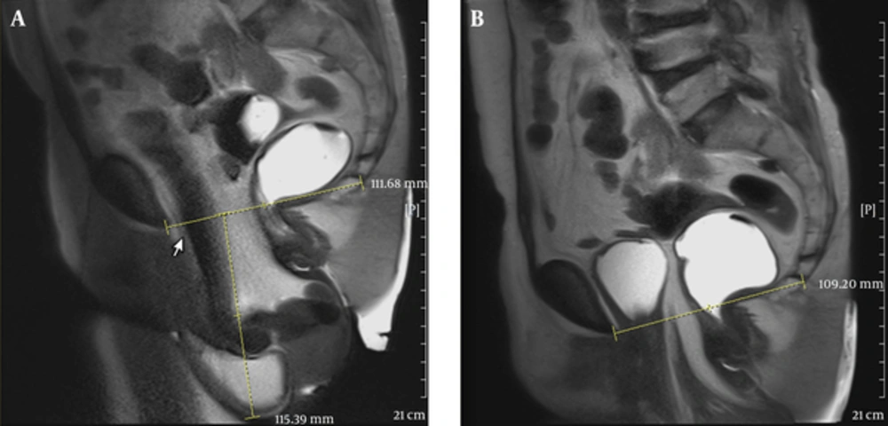 A 54-year-old female with bladder outlet obstruction and perineal mass protrusion. A, Midsagittal T2 HASTE during rest shows the bladder neck at the level of pubococcygeal line (PCL); B, Midsagittal T2 HASTE during straining shows large cystocele, severe apical descent and large enterocele containing illeal loops and mesenteric fat. A 54-year-old female with bladder outlet obstruction and perineal mass protrusion. A, Midsagittal T2 HASTE during rest shows the bladder neck at the level of pubococcygeal line (PCL); B, Midsagittal T2 HASTE during straining shows large cystocele, severe apical descent and large enterocele containing illeal loops and mesenteric fat.