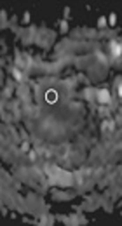 Cover image of the article: Prognostic Value of Diffusion MR Imaging and Clinical-Pathologic Factors in Patients with Rectal Cancer