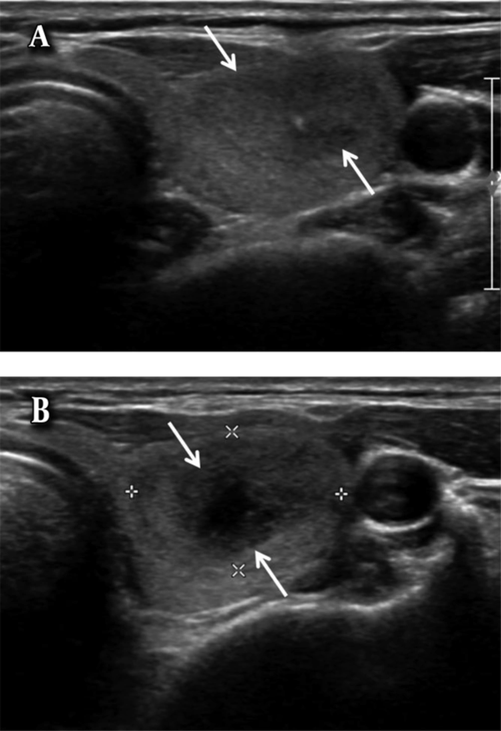 A 43-year-old woman with an intranodular hematoma. A, Axial ultrasonography image shows a hypoechoic solid nodule (arrows) in the left lobe of the thyroid gland. B, Axial ultrasonography image of the nodule after ultrasound-guided fine needle aspiration (US-FNA) shows an anechoic area (arrows) in the central portion of the nodule, suggesting an intranodular hematoma. A 43-year-old woman with an intranodular hematoma. A, Axial ultrasonography image shows a hypoechoic solid nodule (arrows) in the left lobe of the thyroid gland. B, Axial ultrasonography image of the nodule after ultrasound-guided fine needle aspiration (US-FNA) shows an anechoic area (arrows) in the central portion of the nodule, suggesting an intranodular hematoma.