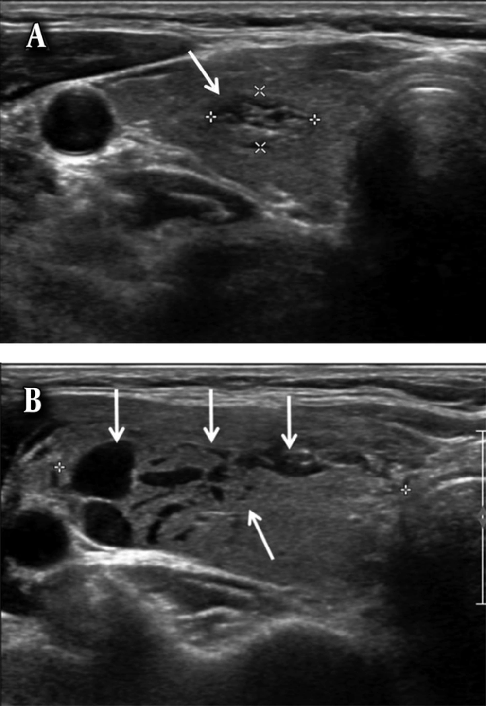 A 59-year-old woman with an intra-parenchymal hematoma. A, Axial ultrasonography image shows a solid nodule with spongiform appearance (arrow) in the right lobe of the thyroid gland. B, Axial ultrasonography image of the nodule after ultrasound-guided fine needle aspiration (US-FNA) shows the intra-parenchymal hemorrhage in the right lobe of the thyroid gland showing multiple linear-shaped anechoic lesions (arrows). The size of the right lobe of the thyroid gland is increased after US-FNA due to intra-parenchymal hemorrhage. A 59-year-old woman with an intra-parenchymal hematoma. A, Axial ultrasonography image shows a solid nodule with spongiform appearance (arrow) in the right lobe of the thyroid gland. B, Axial ultrasonography image of the nodule after ultrasound-guided fine needle aspiration (US-FNA) shows the intra-parenchymal hemorrhage in the right lobe of the thyroid gland showing multiple linear-shaped anechoic lesions (arrows). The size of the right lobe of the thyroid gland is increased after US-FNA due to intra-parenchymal hemorrhage.