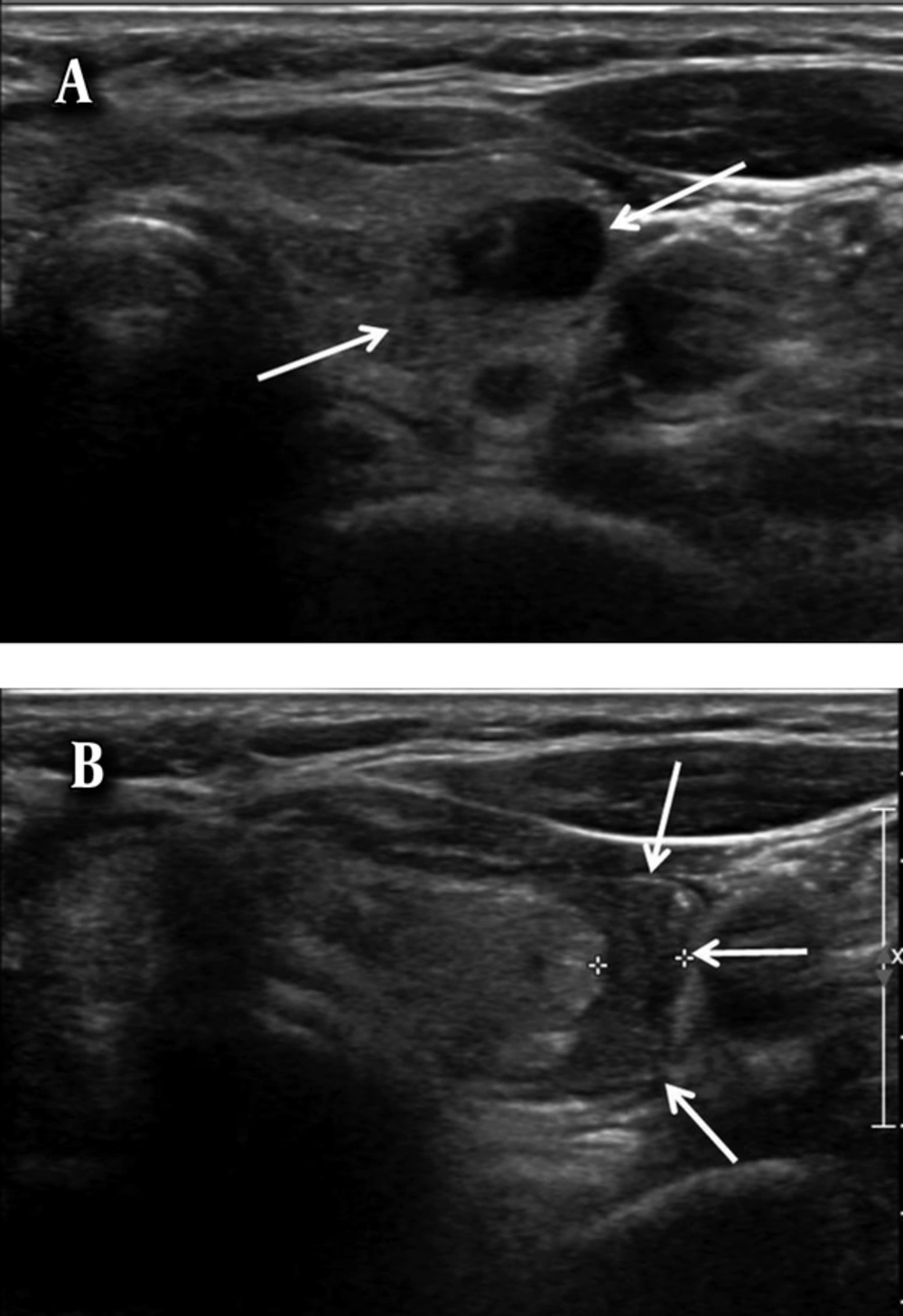A 66-year-old woman with a subcapsular hematoma. A, Axial ultrasonography image shows a predominantly cystic nodule (arrows) in the left lobe of the thyroid gland. B, Axial ultrasonography image of the nodule after ultrasound-guided fine needle aspiration (US-FNA) shows a crescent-shaped hypoechoic subcapsular hematoma (arrows). A 66-year-old woman with a subcapsular hematoma. A, Axial ultrasonography image shows a predominantly cystic nodule (arrows) in the left lobe of the thyroid gland. B, Axial ultrasonography image of the nodule after ultrasound-guided fine needle aspiration (US-FNA) shows a crescent-shaped hypoechoic subcapsular hematoma (arrows).