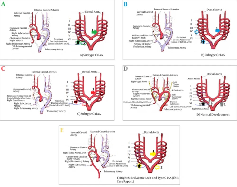 Sites of obliteration that occur in type C interrupted aortic arch (IAA). A, Sites of obliteration that occur in subtype C1 IAA. Arrow A3 points to the posterior site of the sixth arch, which is equivalent with right patent ductus arteriosus (PDA) that is obliterated normally. Obliteration of the left branch of the ascending aorta originated from the aortic sac before separation of the fourth arch, which is equivalent with type C IAA (Arrow A1). Arrow (A2) points to obliteration of distal of right dorsal aorta distal to the left seventh intersegmental artery, which forms on the future right subclavian artery and as a result, the right subclavian artery will originate normally. B, Formation of subtype C 2IAA is shown schematically, arrow B1 shows the common site of obliteration between all of C IAA subtypes. Arrow B3 points to the right PDA that is obliterated in all of subtypes except subtype 3 and the site of obliteration of the right fourth arch, just before right dorsal aorta is shown with arrow B2, these obliterations are accompanied by opening of the dorsal aorta and aberrant right subclavian artery. C, Reveals formation of subtype 3 and arrow C1 points to the common obliteration site in all C IAA types. Arrow C3 shows right PDA, which is open in this subtype and the right subclavian artery originates from that. Arrow C2 shows obliteration of the posterior site of fourth arch just before the right dorsal aorta and therefore, causes an abnormal site for origination and formation. D, Normal obliteration sites. E, Events that happen in major arteries for formation of the abnormalities explained in this case report; arrow E1 shows the common site of obliteration in all subtypes of type C IAA. Arrow E3 shows obliteration of the right PDA and arrow E2 shows obliteration of the left dorsal aorta instead of the right dorsal aorta and as a result formation of right sided aortic arch. (The base of these schematic Figures before changes is extracted from Figure 13.37 of 12th ed. Langman’s Medical embryology 19th ed. but differences between type C IAA subtypes and normal condition and other changes are added by the corresponding author.). Sites of obliteration that occur in type C interrupted aortic arch (IAA). A, Sites of obliteration that occur in subtype C1 IAA. Arrow A3 points to the posterior site of the sixth arch, which is equivalent with right patent ductus arteriosus (PDA) that is obliterated normally. Obliteration of the left branch of the ascending aorta originated from the aortic sac before separation of the fourth arch, which is equivalent with type C IAA (Arrow A1). Arrow (A2) points to obliteration of distal of right dorsal aorta distal to the left seventh intersegmental artery, which forms on the future right subclavian artery and as a result, the right subclavian artery will originate normally. B, Formation of subtype C 2IAA is shown schematically, arrow B1 shows the common site of obliteration between all of C IAA subtypes. Arrow B3 points to the right PDA that is obliterated in all of subtypes except subtype 3 and the site of obliteration of the right fourth arch, just before right dorsal aorta is shown with arrow B2, these obliterations are accompanied by opening of the dorsal aorta and aberrant right subclavian artery. C, Reveals formation of subtype 3 and arrow C1 points to the common obliteration site in all C IAA types. Arrow C3 shows right PDA, which is open in this subtype and the right subclavian artery originates from that. Arrow C2 shows obliteration of the posterior site of fourth arch just before the right dorsal aorta and therefore, causes an abnormal site for origination and formation. D, Normal obliteration sites. E, Events that happen in major arteries for formation of the abnormalities explained in this case report; arrow E1 shows the common site of obliteration in all subtypes of type C IAA. Arrow E3 shows obliteration of the right PDA and arrow E2 shows obliteration of the left dorsal aorta instead of the right dorsal aorta and as a result formation of right sided aortic arch. (The base of these schematic Figures before changes is extracted from Figure 13.37 of 12th ed. Langman’s Medical embryology 19th ed. but differences between type C IAA subtypes and normal condition and other changes are added by the corresponding author.).